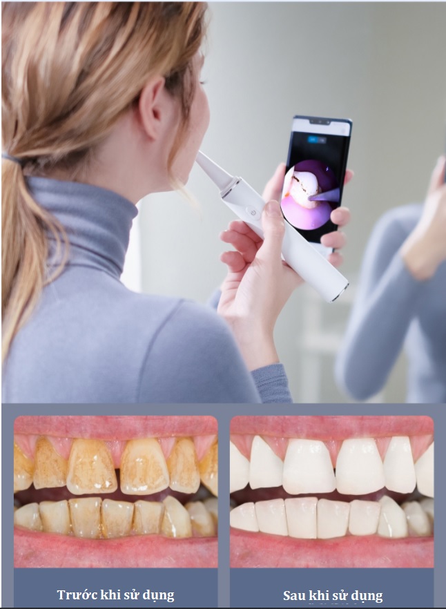 Скалер для удаления зубного камня xiaomi sunuo t11 pro smart visual ultrasonic dental scale